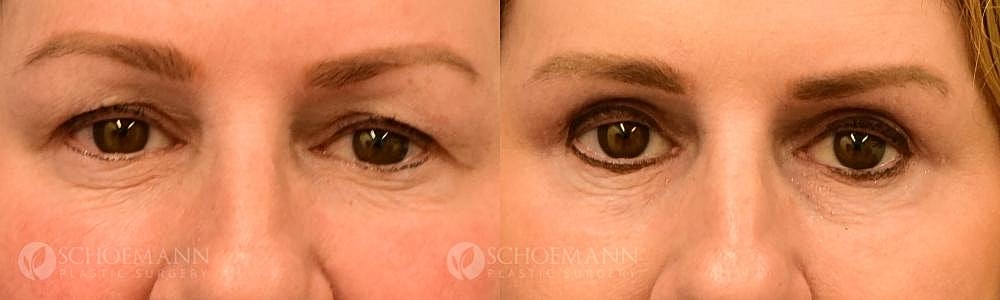 Eyelid Lift Before & After