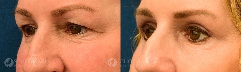 Eyelid Lift Before & After