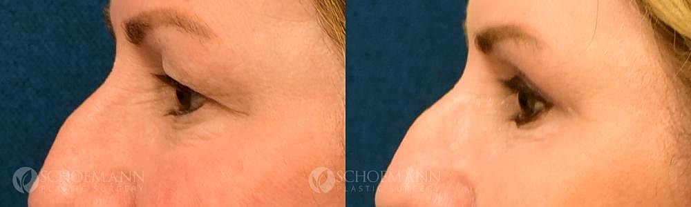 Eyelid Lift Before & After