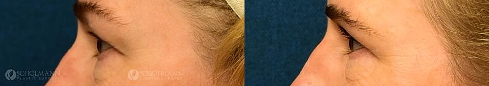 Eyelid Lift Before & After