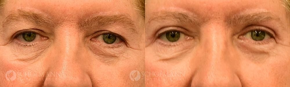 Eyelid Lift Before & After