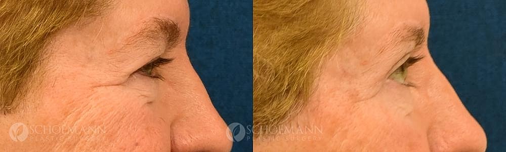 Eyelid Lift Before & After