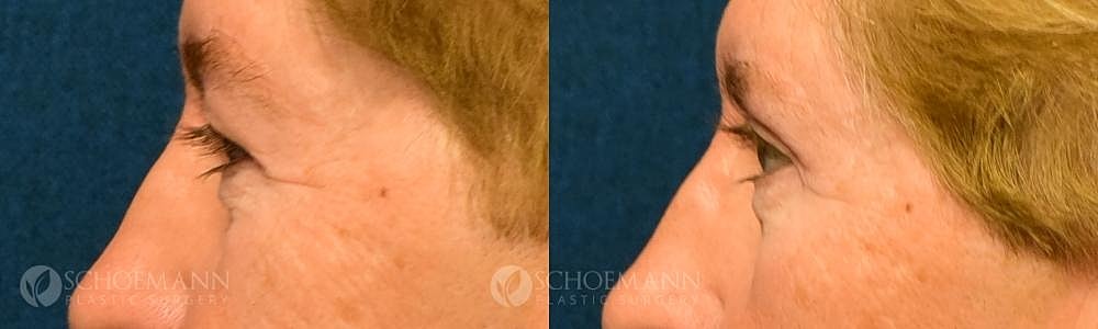 Eyelid Lift Before & After