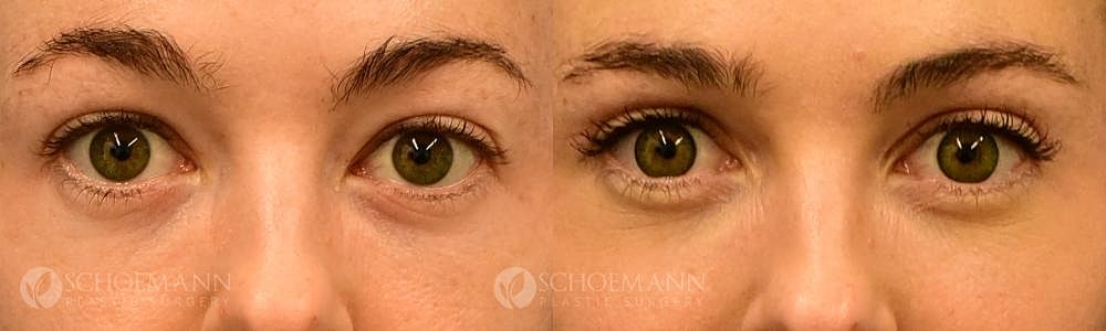 Eyelid Lift Before & After