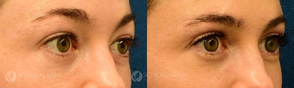 Eyelid Lift Before & After