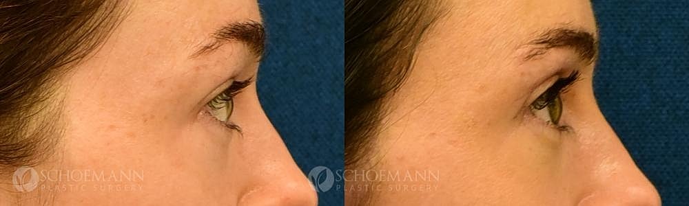 Eyelid Lift Before & After