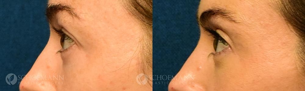 Eyelid Lift Before & After