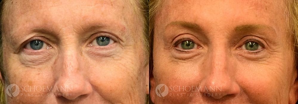Eyelid Lift Before & After