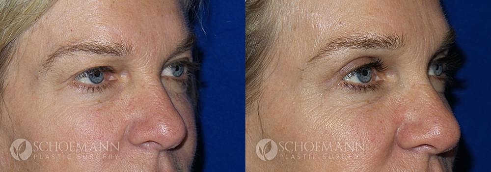Eyelid Lift Before & After