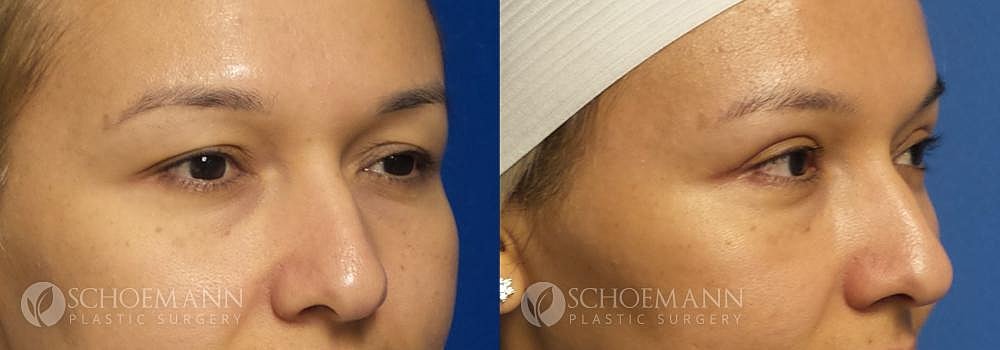 Eyelid Lift Before & After