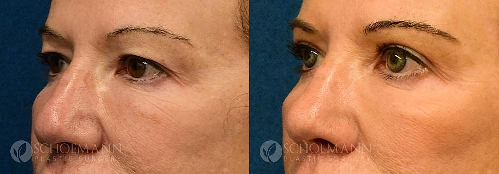 Eyelid Lift Before & After