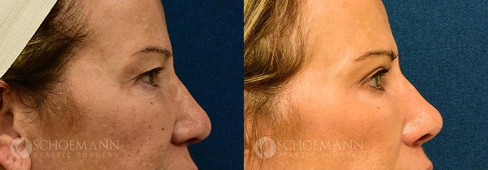 Eyelid Lift Before & After