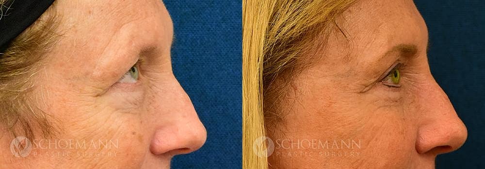 Eyelid Lift Before & After