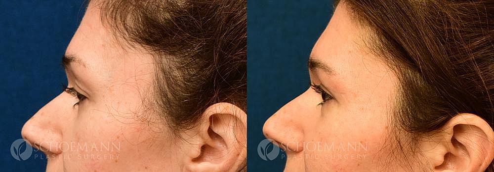 Eyelid Lift Before & After