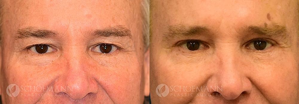 Eyelid Lift Before & After