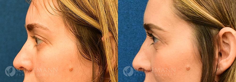 Eyelid Lift Before & After