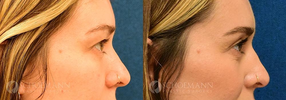 Eyelid Lift Before & After