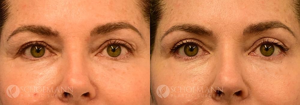 Eyelid Lift Before & After