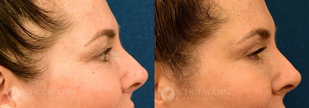 Eyelid Lift Before & After