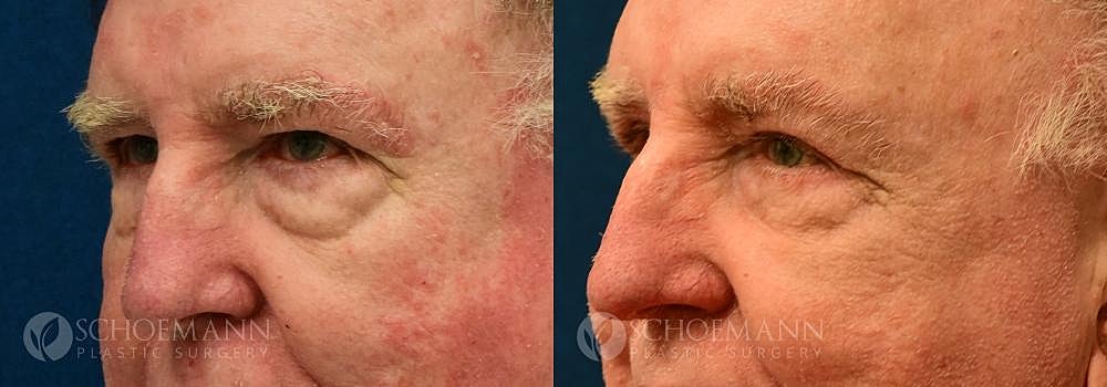 Eyelid Lift Before & After