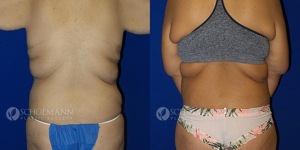 After Weight Loss Surgery Before & After