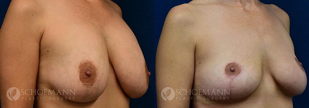 Breast Revision Before & After