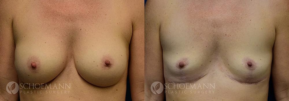 Breast Revision Before & After