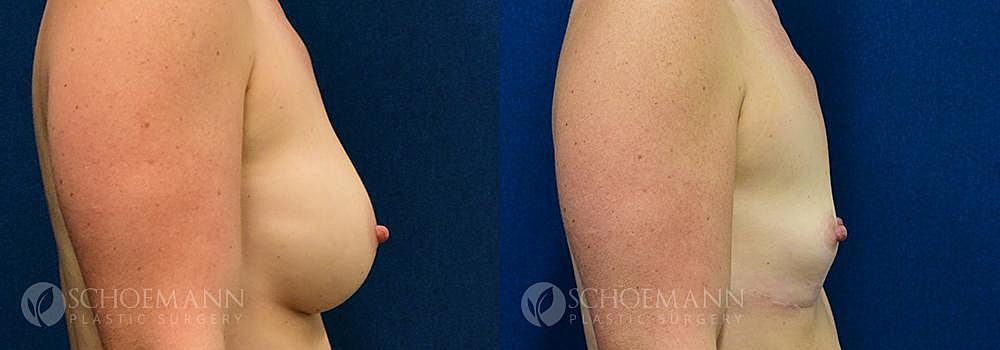 Breast Revision Before & After