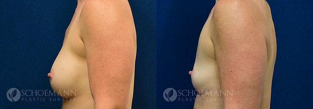 Breast Revision Before & After