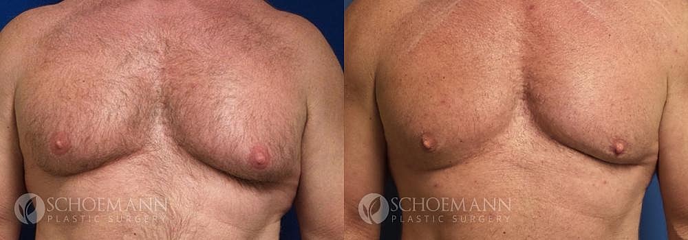 Gynecomastia Before & After