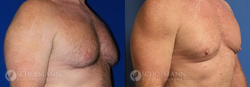 Gynecomastia Before & After