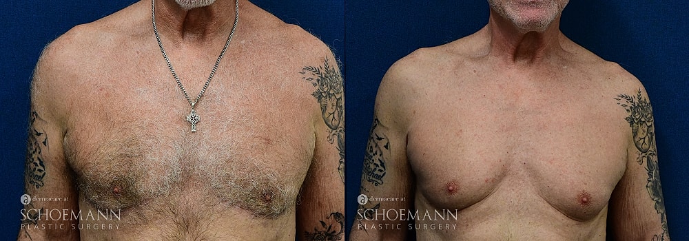 Chest transformation before and after surgery.