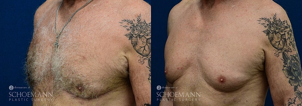 Before and after chest contouring procedure.