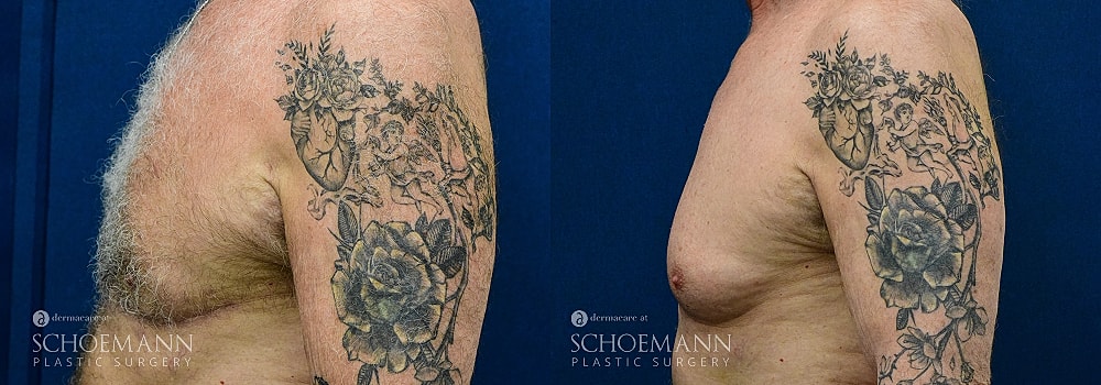 Before and after tattoo removal on upper arm.