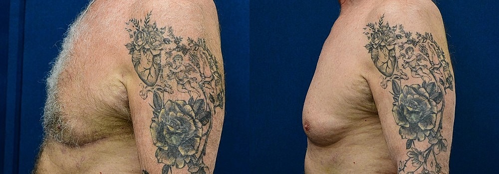 Gynecomastia Before & After