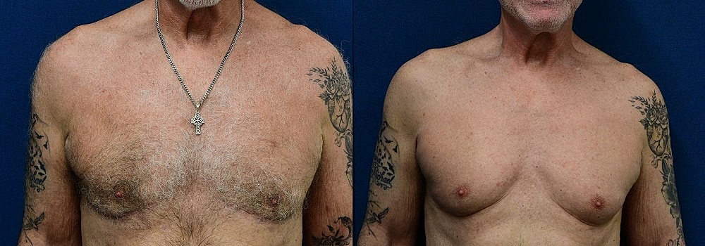 Gynecomastia Before & After