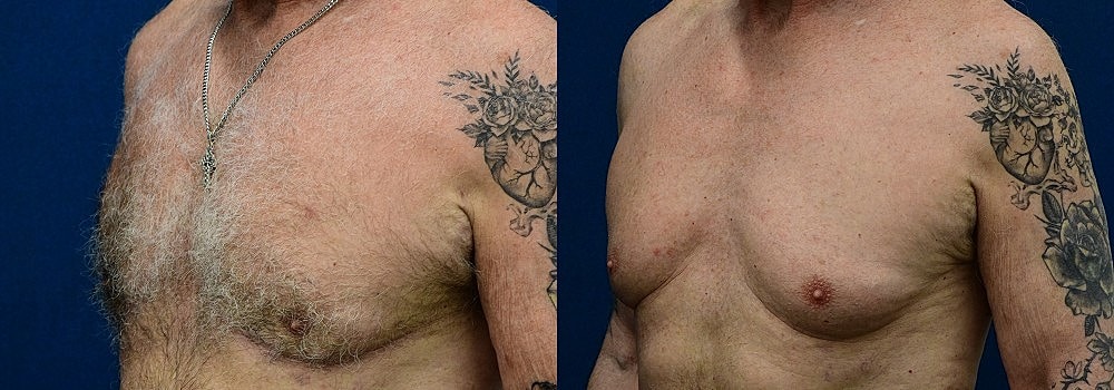 Gynecomastia Before & After