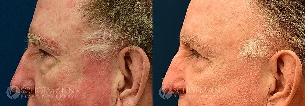 Blepharoplasty Before & After