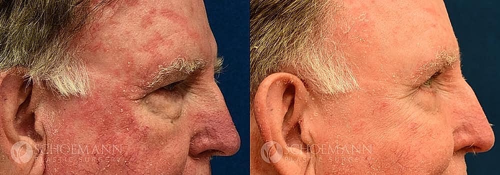 Blepharoplasty Before & After