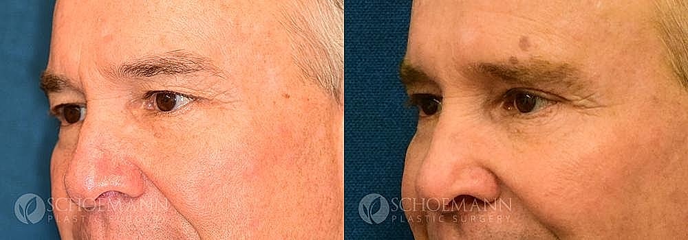 Blepharoplasty Before & After