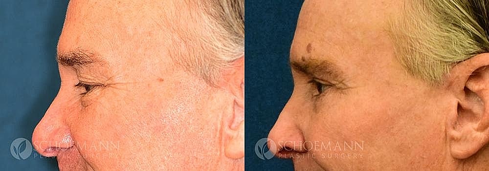 Blepharoplasty Before & After