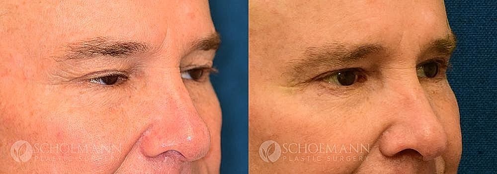 Blepharoplasty Before & After