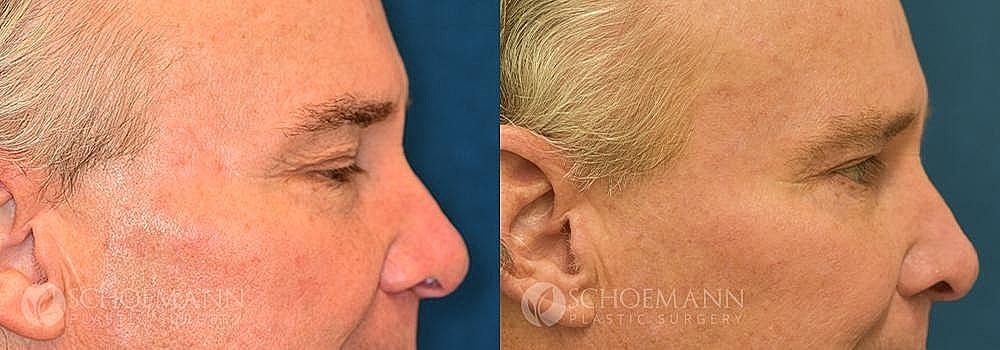 Blepharoplasty Before & After