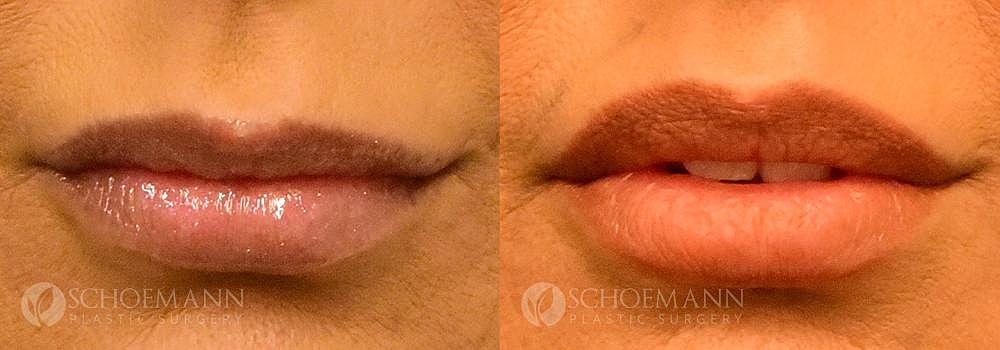Lip Lift Before & After