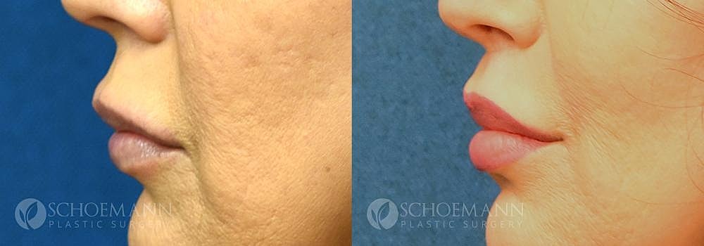 Lip Lift Before & After