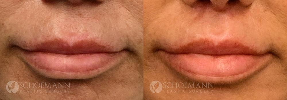 Lip Lift Before & After