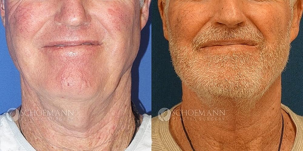 Neck Lift for Men Before & After