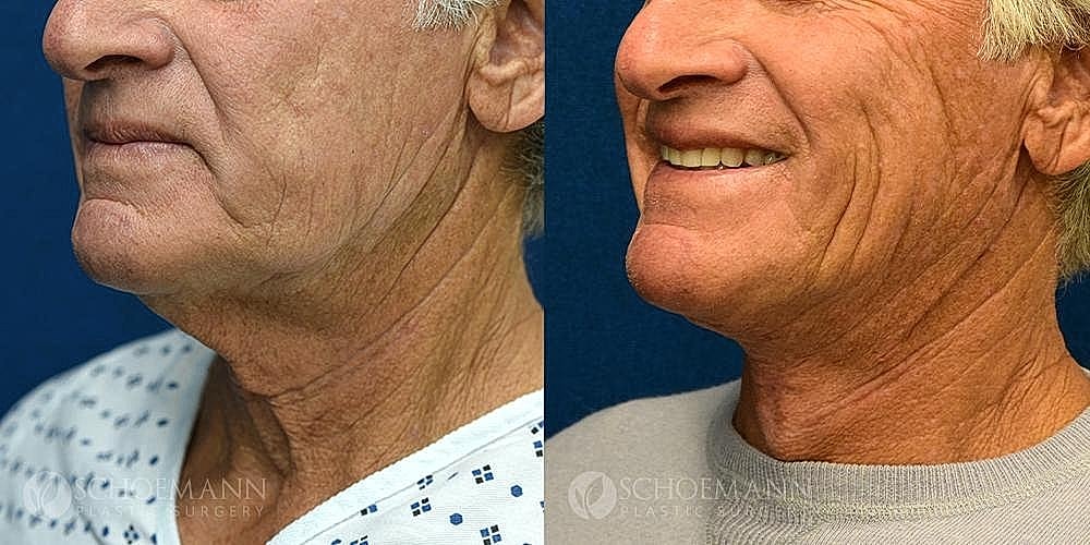Neck Lift for Men Before & After