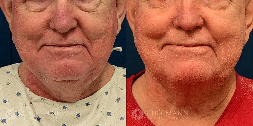 Neck Lift for Men Before & After