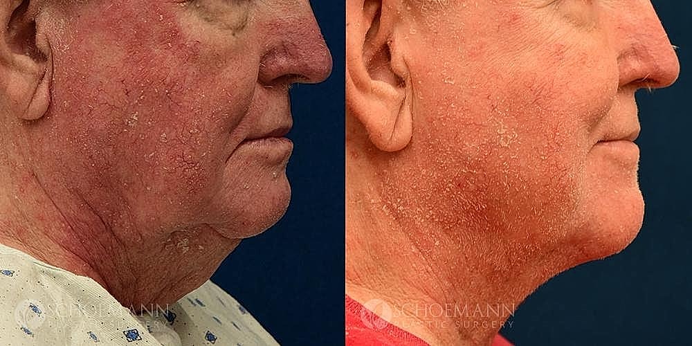 Neck Lift for Men Before & After